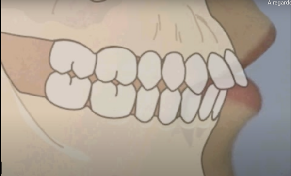 Traitement orthodontique avec extractions, pour la correction d’une malocclusion de Classe II avec bi-protrusion