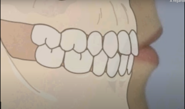 Traitement orthodontique avec extractions, pour la correction d’une malocclusion de Classe I avec DDM