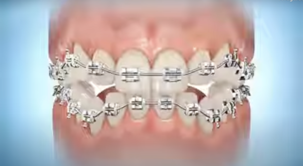 Elastique d'intercuspidation