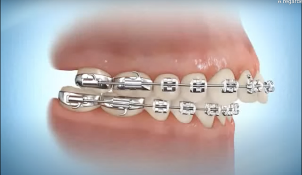 Elastique inter maxilaire de classe II