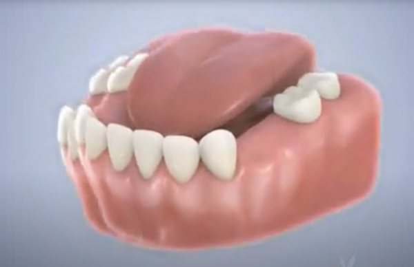 Arc lingual (mainteneur d'espace)