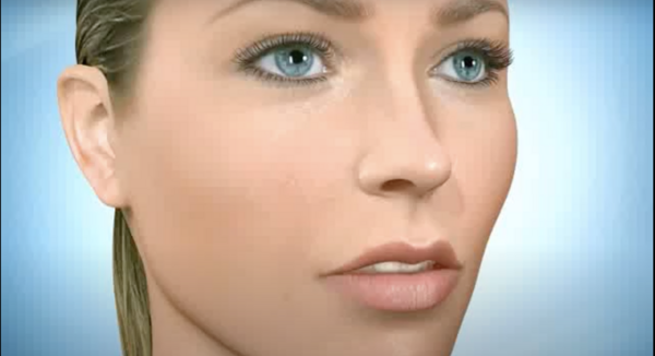 Collage des brackets