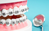 Brackets, traitement orthodontique, Mans 72000