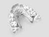 Différentes étapes d'un traitement orthodontique, Mans 72000