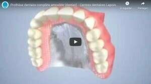 Prothèse dentaire complète amovible (dentier)