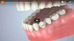 Prothèse dentaire partielle (partiel)