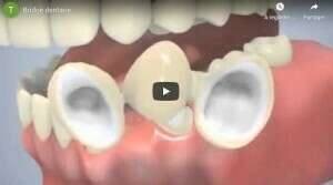 Bridge dentaire