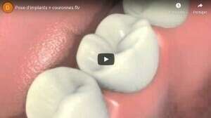 Pose d'implants et couronnes