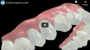 Prothèse implanto-portée