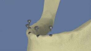 Stabilisation d'une prothèse par une barre sur 4 implants