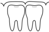 Réhabilitation complexe de la denture