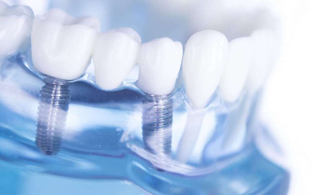 Pose d'implants dentaires