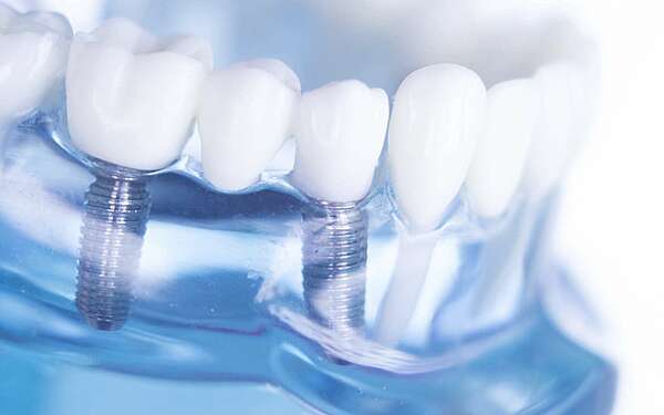 Pose d'implants dentaires