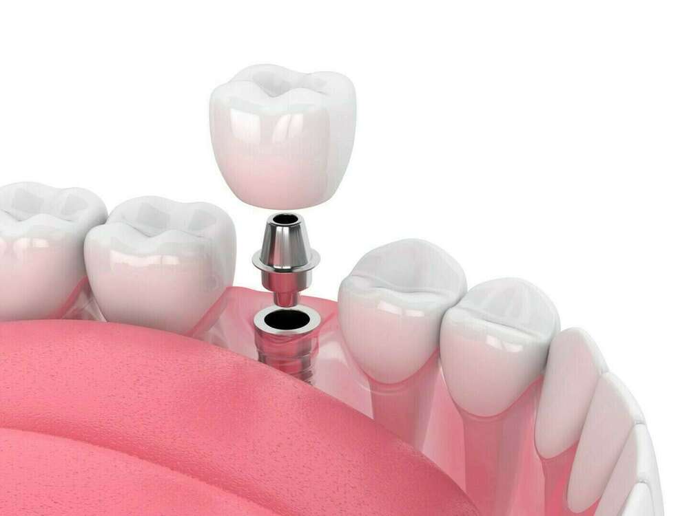 Prothèse sur implant dd