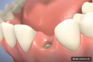 Pose d'un implant dentaire en 2 temps avec un pilier titane