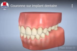 Couronne sur implant dentaire