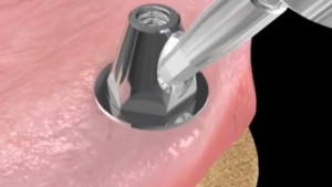 Prothèse implanto-portée