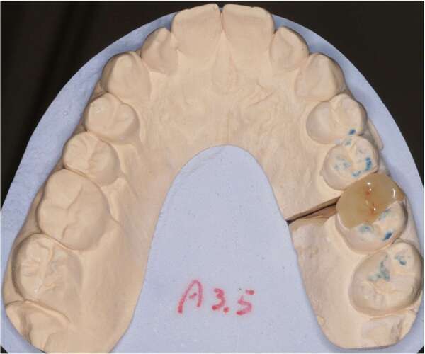 Cas de dévitalisation et réalisation d'une restauration céramique de Type Onlay