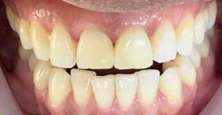 Eclaircissement dentaire 