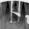Obturation 31 41