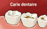 CARIES ET SOINS DES CARIES