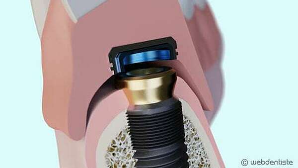 Stabilisation d'une prothèse par 2 boutons pressions