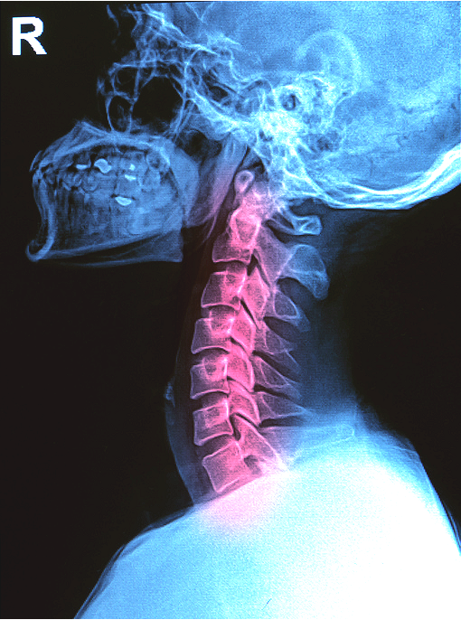 Textneck ou Techneck