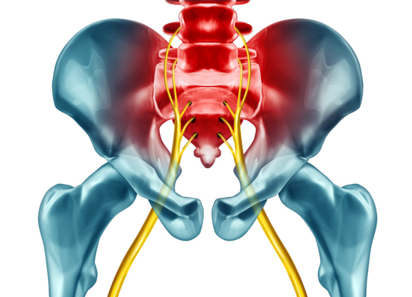 Comprendre la corrélation entre la scoliose et la sciatique