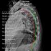 Analyse radiographique d’une hypercyphose thoracique au CCCV à Paris