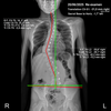 Radiographie d’une scoliose avec mesure des courbures vertébrales et de l’angle de Cobb