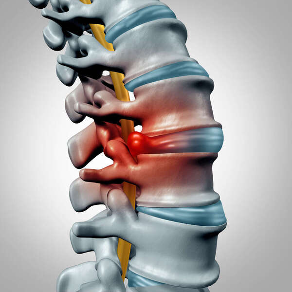 Cervical Foraminal Stenosis: What Does Your Report Mean?