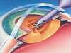 Schéma de chirurgie de la cataracte avec implant oculaire