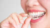Soins d'orthodontie, cabinet Dr ELLOUK Conflans-Sainte-Honorine