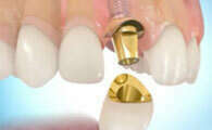 Prothèse dentaire sur implant