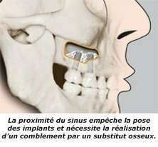 Les comblements de sinus ou sinus lift par voie crestale