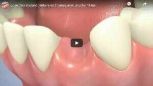 Pose d'un implant dentaire en 2 temps avec un pilier titane