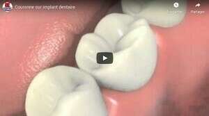 Couronne sur implant dentaire
