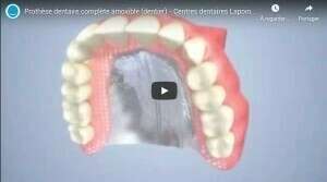 Prothèse dentaire complète amovible (dentier)