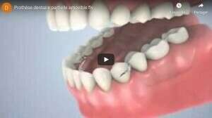 Prothèse dentaire partielle (partiel)