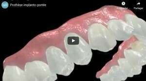 Prothèse implanto-portée