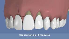La technique de la greffe de gencive
