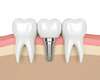 Dents d'implantation dentaire avec vis d'implant