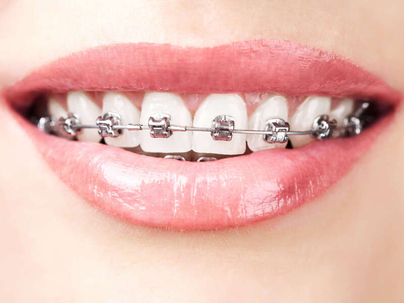 Appareils multi-attaches / bagues - cabinet milesker - Dr GENY et Dr VINCENT