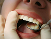 Examen des dents et des gencives au miroir dentaire