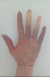 maladie de Raynaud etiopathe