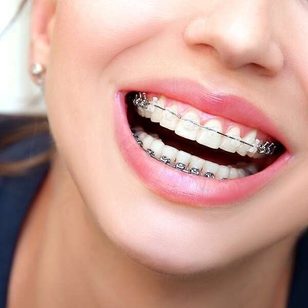 LES APPAREILS ORTHODONTIQUES AUTOLIGATURANTS