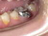 Incidents Orthodontiste Quid Helix 63