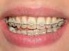 Traitement en technique vestibulaire réalisable au cabinet de l'orthodontiste Muriel Galloy au Puys-de-dôme (63).