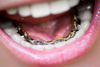 Sourire d'enfant avec appareil d'orthodontie dentaire