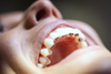 Sourire d'enfant avec appareil d'orthodontie dentaire